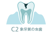 C2 象牙質の虫歯