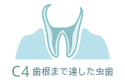 C4 歯根まで達した虫歯