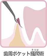 歯周ポケット掻爬（そうは）術